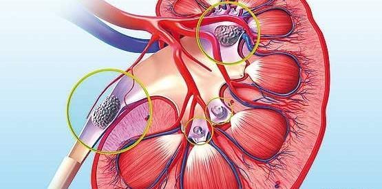 عکس دستگاه لیزر کلیه