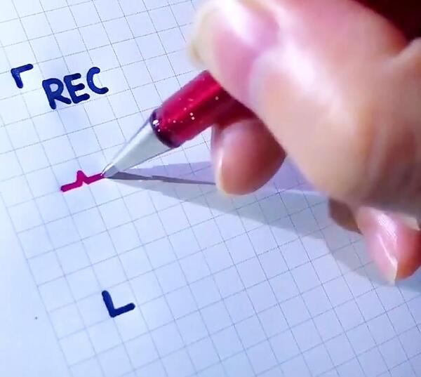 عکس ضربان قلب حنا