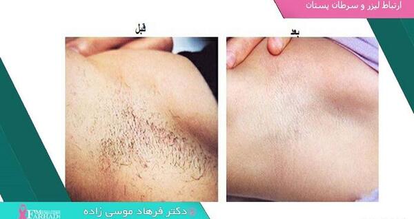 عکس سوتی لیزر نی نی سایت