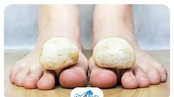 عکس ناخن قارچ گرفته