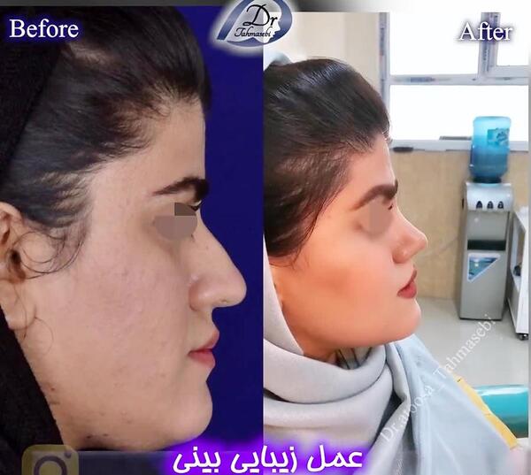 عکس سوگل طهماسبی قبل از عمل بینی