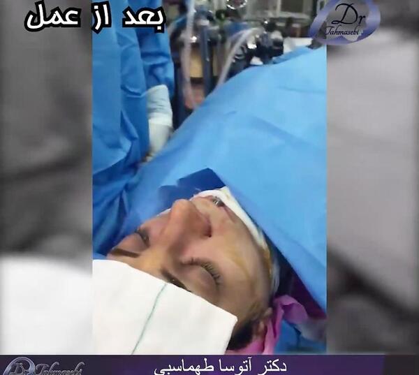عکس سوگل طهماسبی قبل از عمل بینی