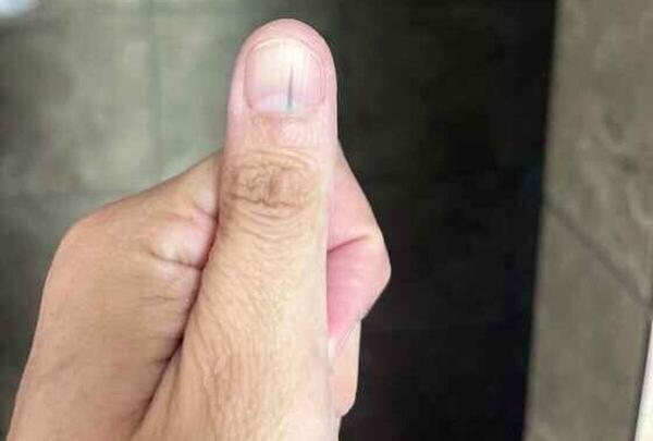 عکس ناخن افتاده
