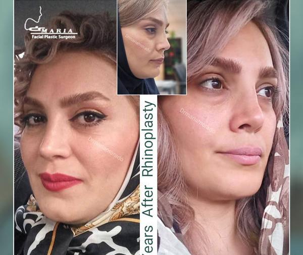 عکس آتلیه برای جراحی بینی