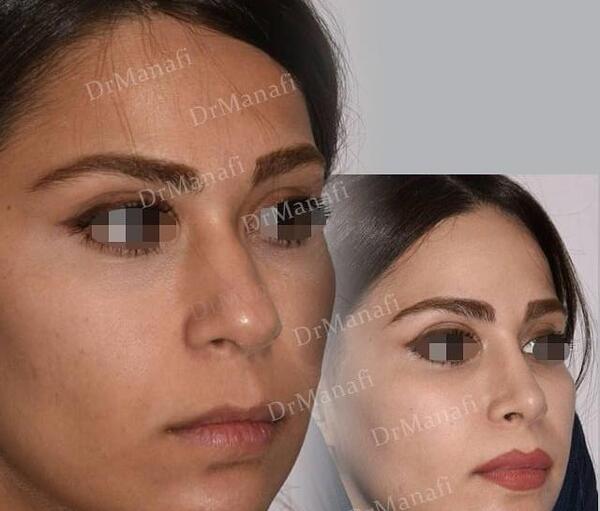 عکس آتلیه برای جراحی بینی