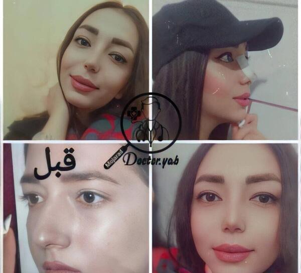 عکس آتلیه برای جراحی بینی