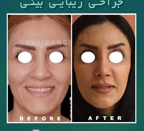 عکس آتلیه برای جراحی بینی