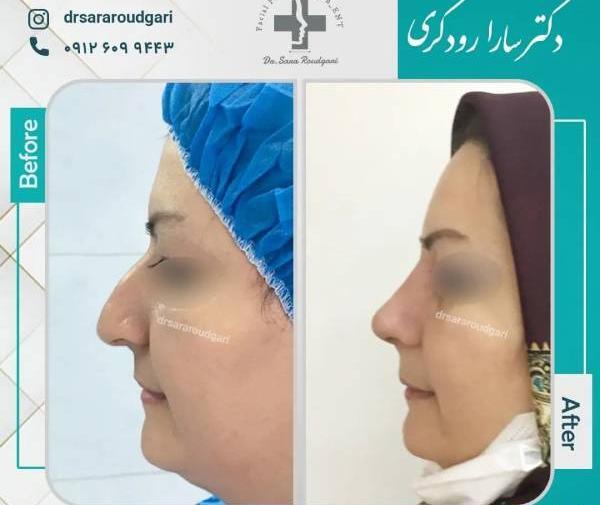 عکس آتلیه برای جراحی بینی