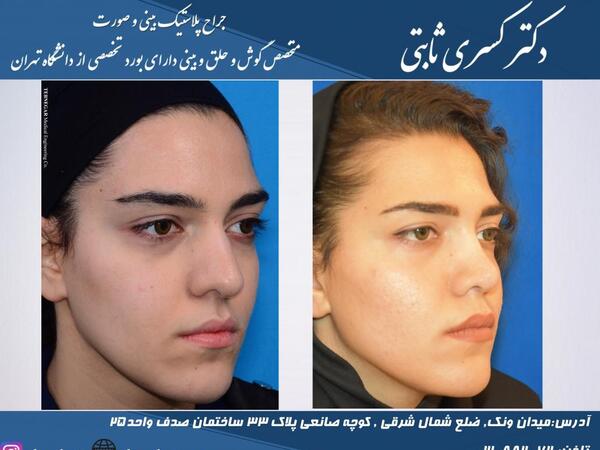 عکس آتلیه برای جراحی بینی