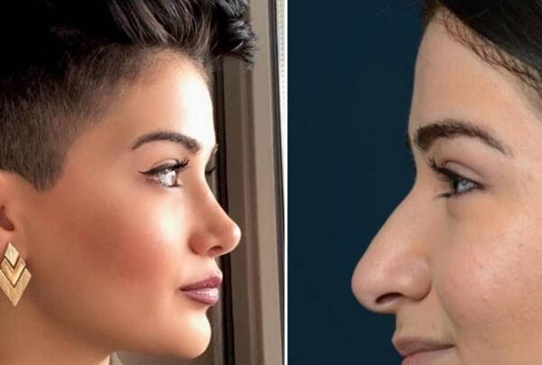 عکس آتلیه برای جراحی بینی