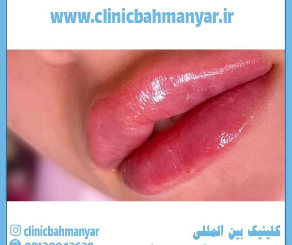 عکس قیمت تزریق ژل لب مدل روسی نی نی سایت