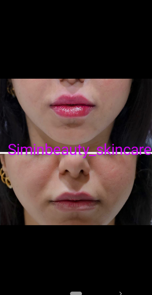 عکس قیمت تزریق ژل لب مدل روسی نی نی سایت