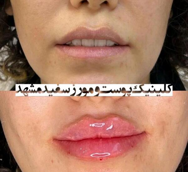 عکس قیمت تزریق ژل لب مدل روسی نی نی سایت