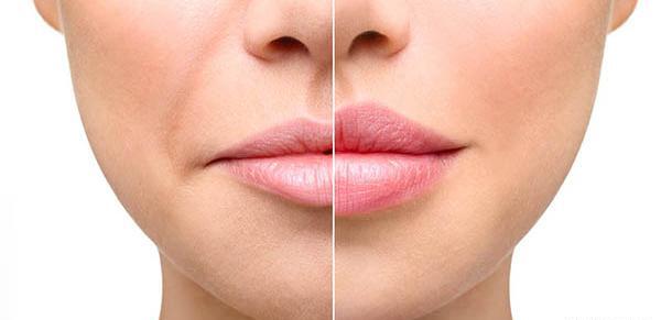 عکس قیمت تزریق ژل لب مدل روسی نی نی سایت