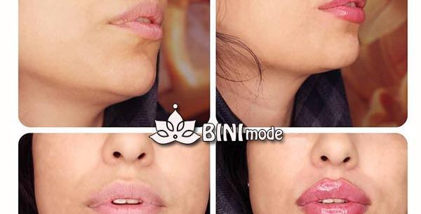عکس قیمت تزریق ژل لب مدل روسی نی نی سایت
