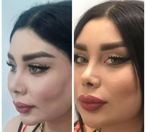 عکس قیمت تزریق ژل لب مدل روسی نی نی سایت