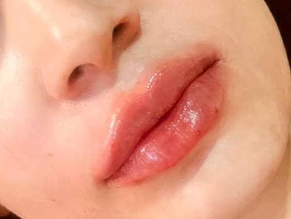 عکس قیمت تزریق ژل لب مدل روسی نی نی سایت