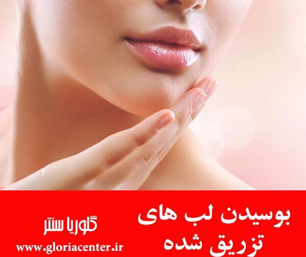 عکس قیمت تزریق ژل لب مدل روسی نی نی سایت