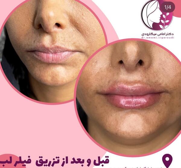 عکس قیمت تزریق ژل لب مدل روسی نی نی سایت