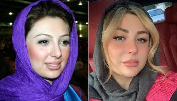 عکس قبل جراحی نیوشا ضیغمی