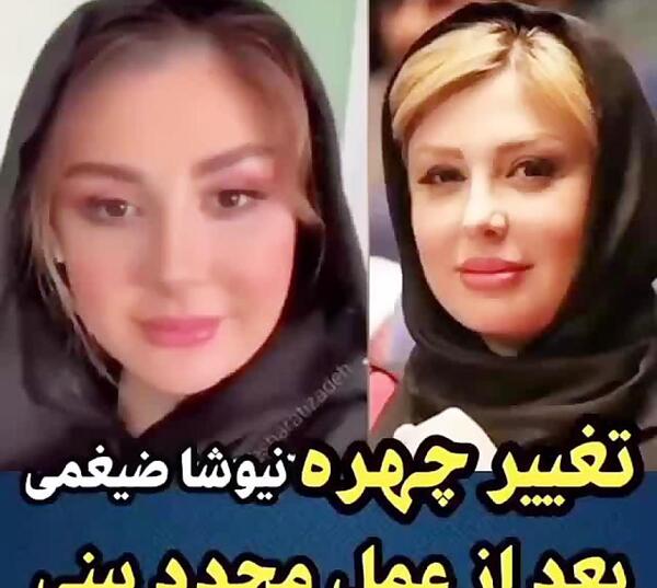 عکس قبل جراحی نیوشا ضیغمی