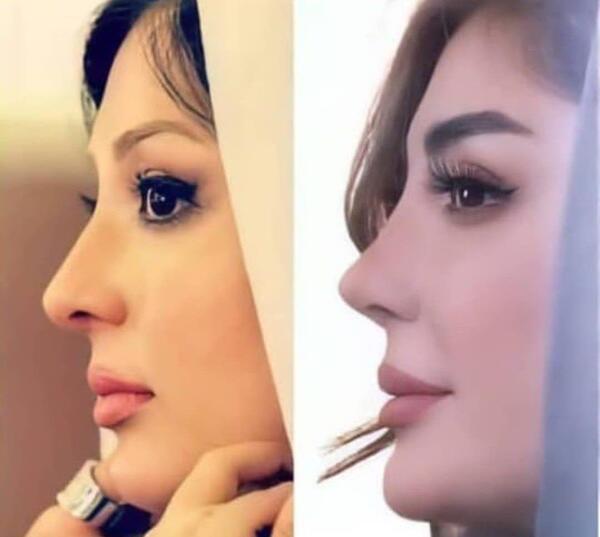 عکس قبل جراحی نیوشا ضیغمی