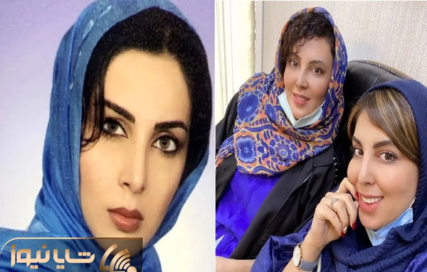 عکسهای لیلا بلوکات قبل از عمل بینی