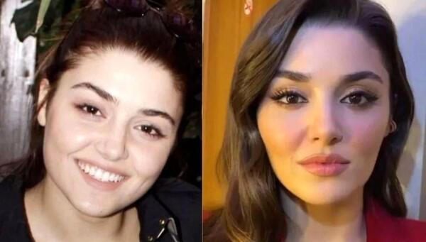 عکس های هانده ارچل قبل از عمل زیبایی