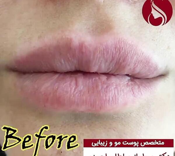عکس قبل و بعد ژل لب