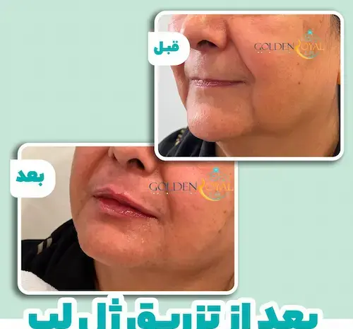 عکس قبل و بعد ژل لب