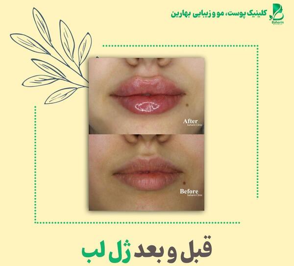 عکس قبل و بعد ژل لب