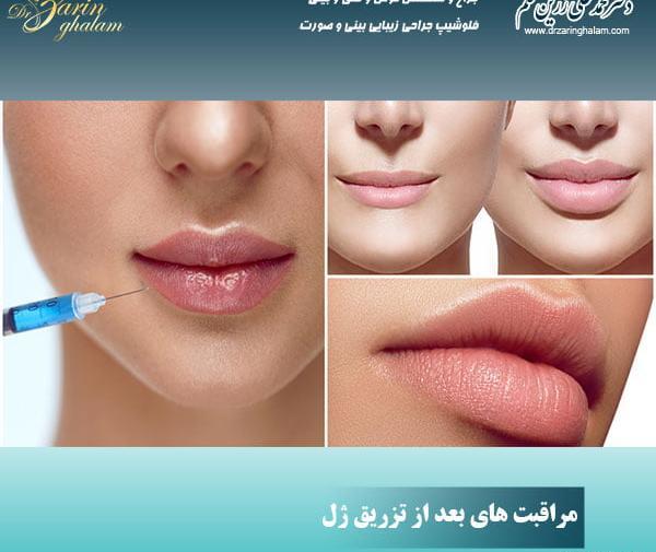 عکس قبل و بعد ژل لب