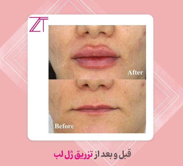 عکس قبل و بعد ژل لب