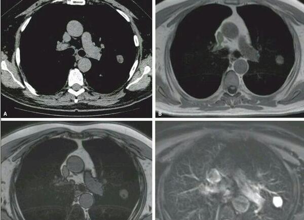 عکس ام ار ای ریه