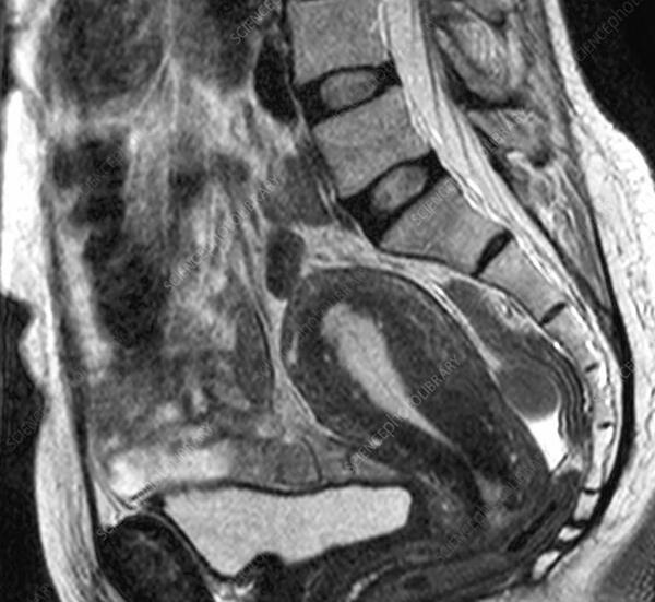 عکس ام ار ای ریه