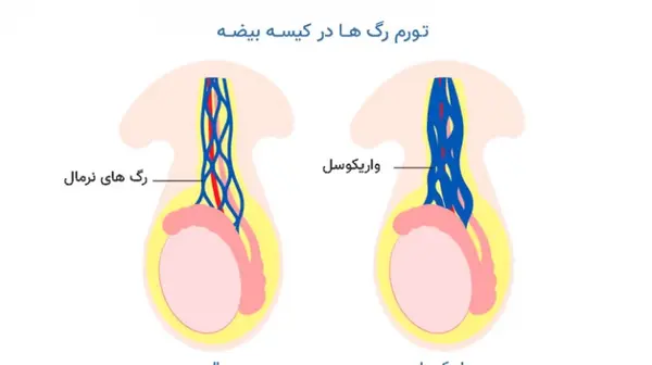 عکسی از واریکوسل