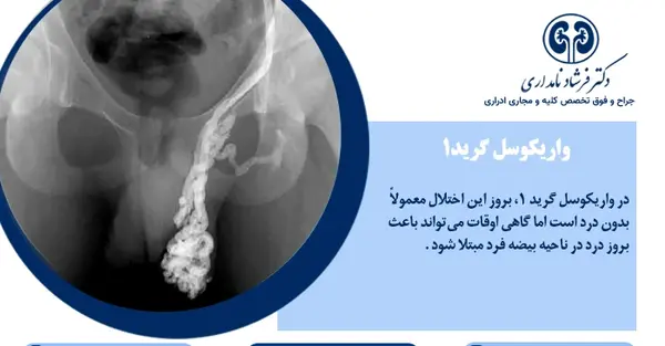 عکسی از واریکوسل