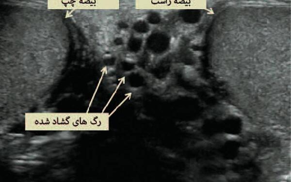 عکسی از واریکوسل