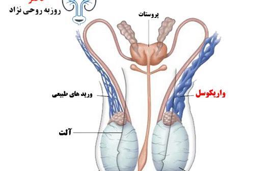 عکسی از واریکوسل