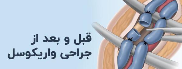 عکسی از واریکوسل