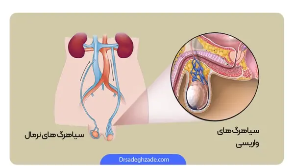 عکسی از واریکوسل