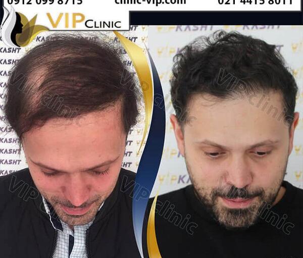 عکس کریشی چشم ابرو
