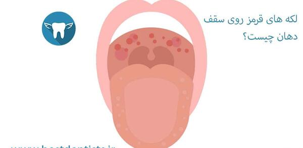 عکس قرمز شدن گلو