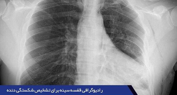 عکس ریه سالم انسان