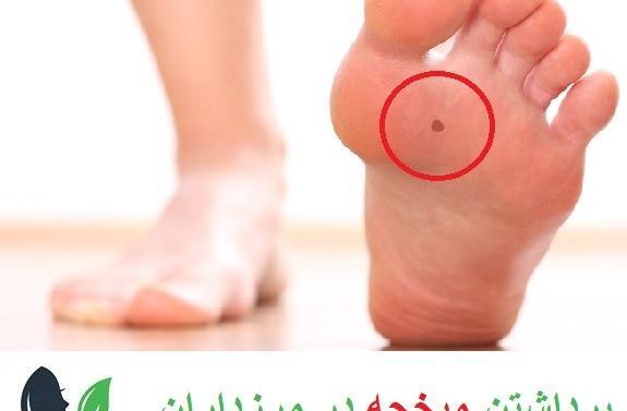 عکس میخچه پا