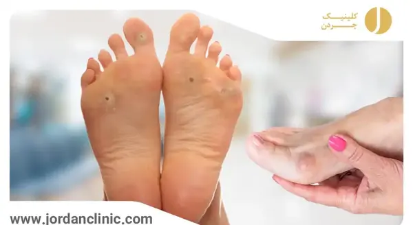عکس میخچه پا