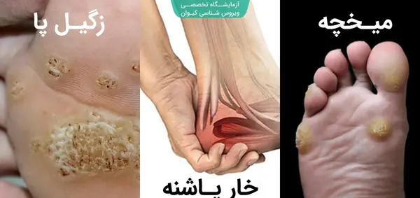 عکس میخچه پا