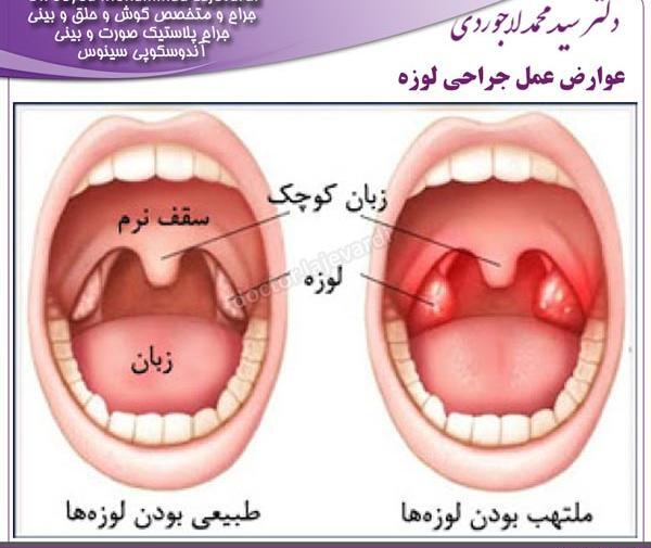 عکس حلق کنی