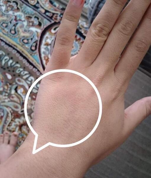 عکس بازوی کبود شده