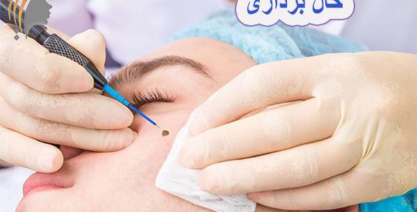 عکس دستگاه لیزر خال